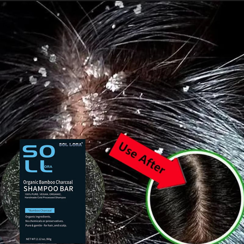 Hair Care Dandruff - 빠른 비듬 방지 헤어 트리트먼트 비누